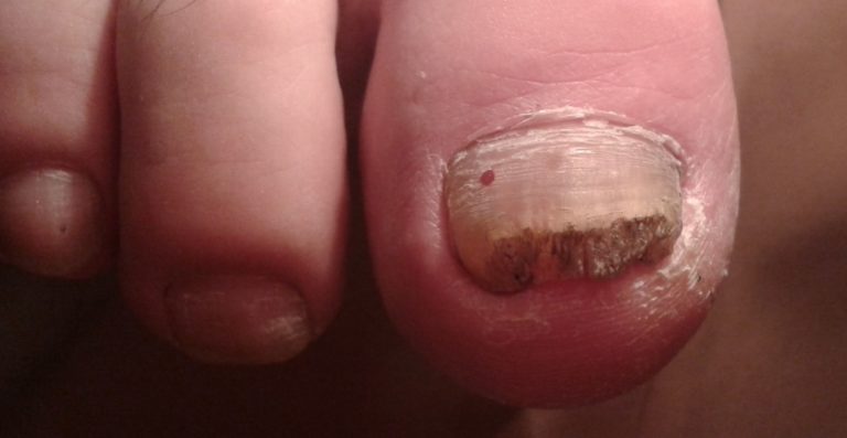 Чем опасен грибок ногтей на ногах для организма: грипп, осложнения и последствия болезни