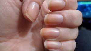 Средство от грибка ногтей на руках: эффективные противогрибковые таблетки и капли, мази и кремы5