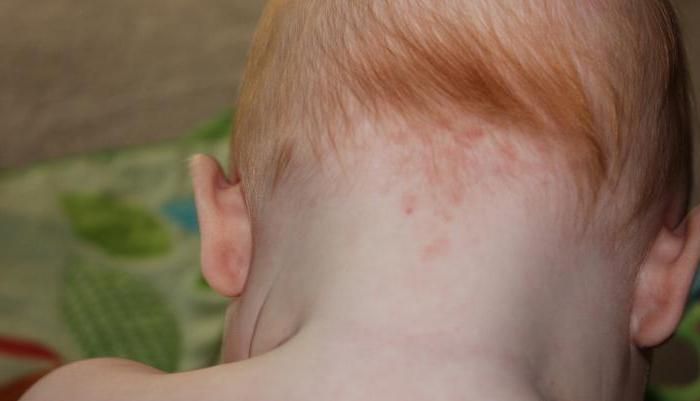 Когда у детей появляются родинки: причины появления многих невусов и какие из них опасны для малыша4