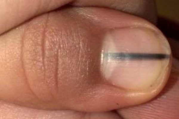 Черное пятно на ногте большого пальца ноги: причины появления, методы устранения проблемы