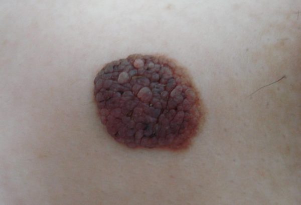 Виды родинок у человека: доброкачественные и злокачественные 13