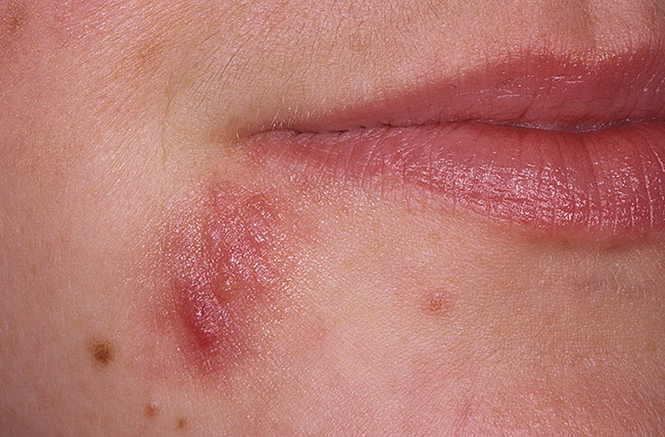 Как удаляют родинки лазером: как это происходит, метод опасен, остаются рубцы, противопоказания2