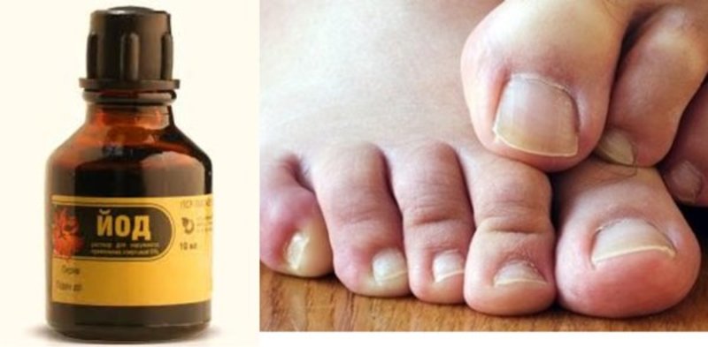Лечение грибка ногтей йодом: симптомы, народные методы лечения онихомикоза ногтевой пластины на стопах9