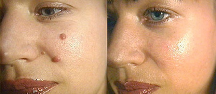 Как удаляют родинки лазером: как это происходит, метод опасен, остаются рубцы, противопоказания1