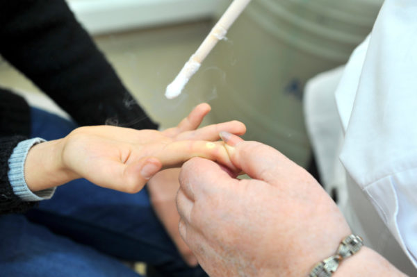 Воспаленная папиллома: причины воспаления, что делать