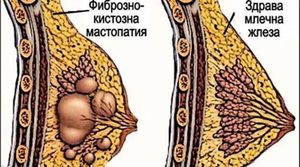 Как лечить фиброзно кистозную мастопатию Лечение заболевания