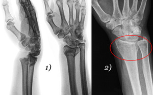 Перелом лучезапястной кости Лечение перелома лучевой кости со смещением