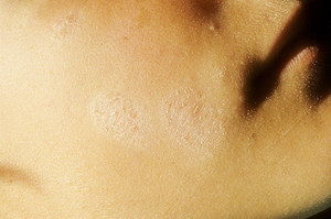 Что такое простой лишай Лечение белого лишая