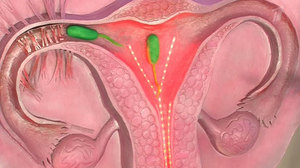 Цервикальный канал во время беременности Функции цервикального канала во время беременности
