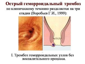 Виды геморроя Разновидности форм геморроя