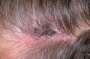 Этапы болезни Симптомы герпеса на голове