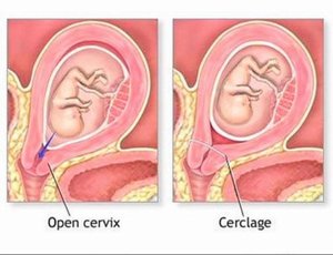 Признаки гипертонуса матки Как лечить гипертонус матки