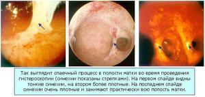 Гистероскопия при спайках внутри матки Гистероскопия - обследование матки на предмет спаек