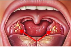 Гнойная ангина Гнойная ангина в горле