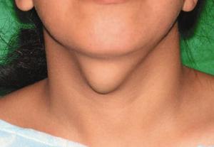 Гнойная киста щитовидки у ребенка Симптомы гнойной кисты щитовидной железы