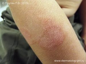 Грибок на коже Грибок на коже рук