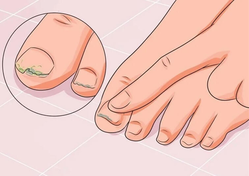 Грибок ногтей: дешевые и эффективные средства для лечения