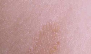 Признаки лишая у взрослых проявление лишая у человека