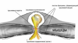 Лечение грыжи Способы леечения грыжи