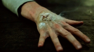 Ожог щелочью Как выглядит ожог щелочью