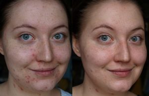 Самые эффективные антибиотики при угревой сыпи антибиотики при кожных высыпаниях