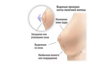 Профилактика образования кисты в молочной железе у женщин Профилактика образования кисты в груди у женщин