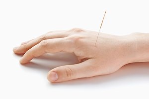 Что такое иглоукалывание Чем полезно иглоукалывание и при каких болезнях помогает