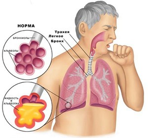 Пневмония Последствия скопления слизи в горле