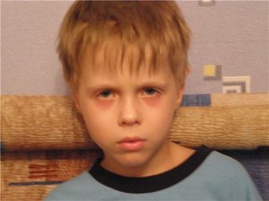 Методы леченяи синяков Как лечить круги под глазами