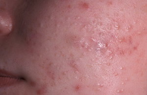 Угри на лице Угри на лице у подростка