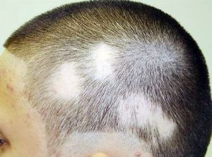 Лечение лишая у человека в домашних условиях Как вылечить лишай дома