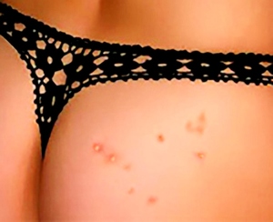 Как избавиться от прыщей на ягодицах Лечим прыщи на попе - основные методы