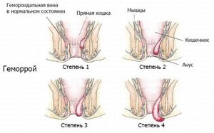 Диета при геморрое Как питаться при геморрое