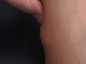 Диагностика липомотоза Диагностирование липомотоза