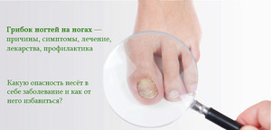 Что такое грибок ногтей Грибок ногтей