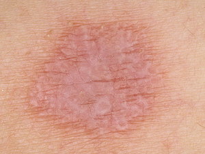 Розовый лишай как аллергическое проявление Розовый лишай на коже