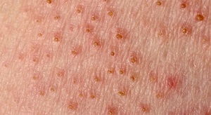 Как вылечить лишай у человека Как лечить лишай у человека