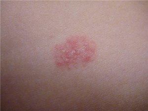 Причины появления водянистых прыщей Почему появились водянистые прыщи