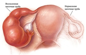 Возможные осложнения при воспалении придатков Проявление заболевания