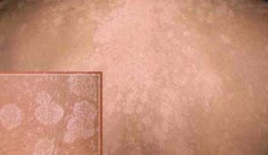 Как лечить разноцветный лишай Медикаменты при цветном лишае