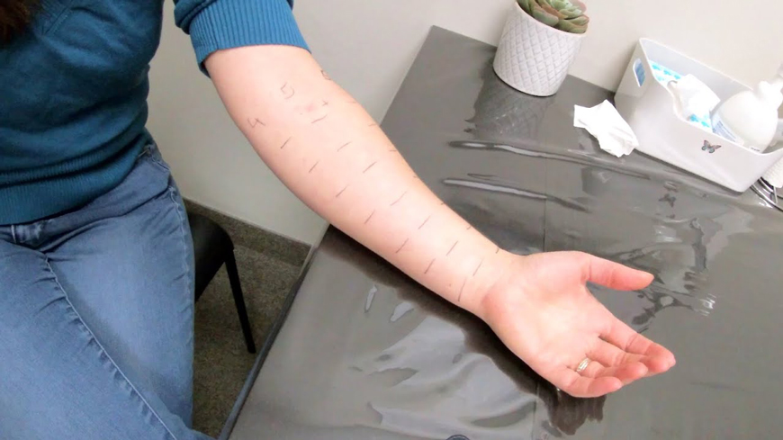 Как подготовиться и провести тест на аллергию?