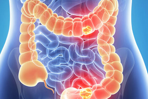 Причины рака кишечника и прямой кишки Почему возникает болезнь рак