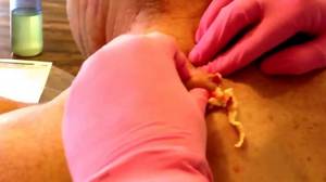 Вскрытие фурункула Лечение фурункула в больнице