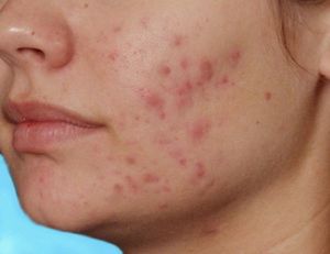 Медикаментозная терапия Как избавиться от пятен на лице