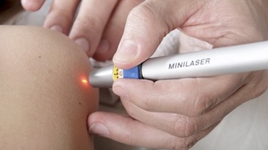 Лазерное удаленияе папиломы Способы удаления папиллом