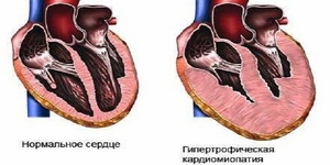 Кардиопатия при мышечной дистрофии Дюшенна Кардиопатия