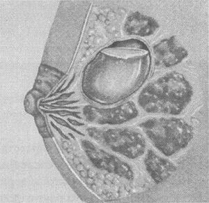 Диагностика кистозного образования в груди Диагностика кистозного образования в груди у женщин