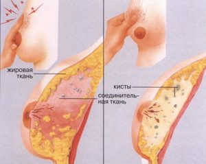 Узи молочной железы Какие обследования необходимо провести