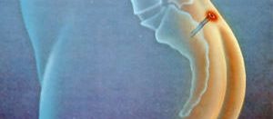 Причины развития кисты копчика Выделения из копчика