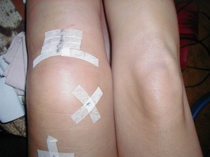 Колено после операции - фото пациента После операции артроскопии больному понадобится реабилитация